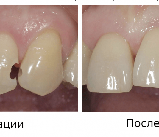 Реставрация зуба: что из себя представляет и когда проводится