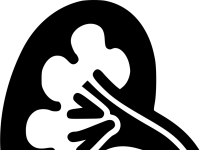 5 причин обрати клініку «Urologist Valetskyi», якщо вам потрібна літотрипсія