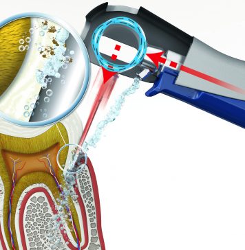 Особенности лечения десен аппаратом Вектор