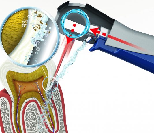 Особенности лечения десен аппаратом Вектор