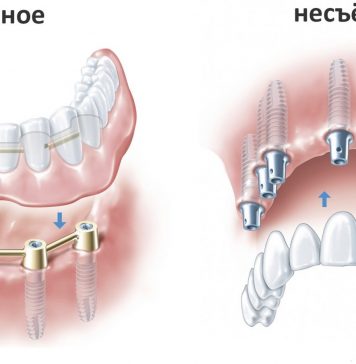 Современные методы протезирования зубов