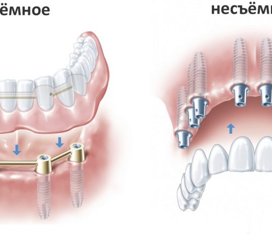Современные методы протезирования зубов