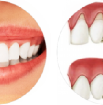 Гингивопластика: показания к назначению процедуры