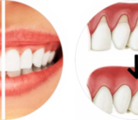 Гингивопластика: показания к назначению процедуры