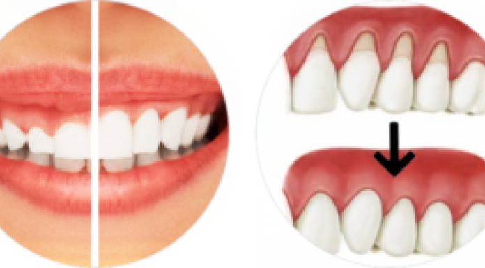 Гингивопластика: показания к назначению процедуры