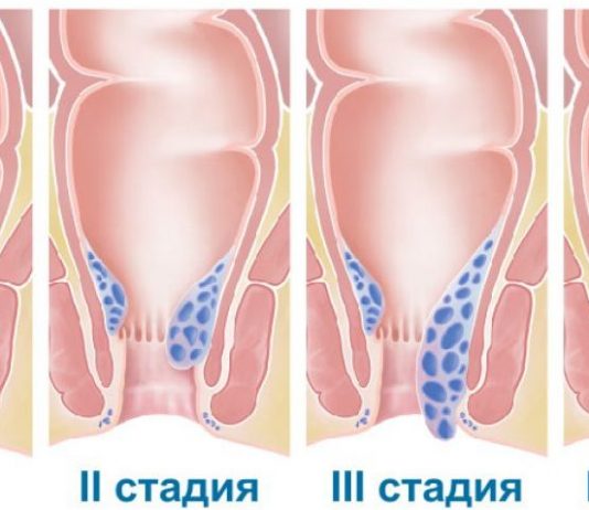 Хронический геморрой: причины появления и особенности лечения