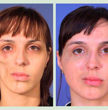 Особенности реконструктивной пластики лица