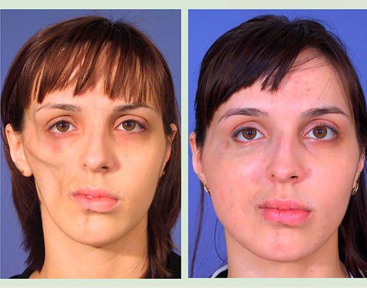 Особенности реконструктивной пластики лица