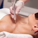 Показания для удаления папиллом лазером