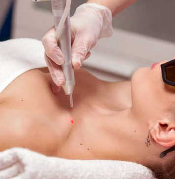 Показания для удаления папиллом лазером