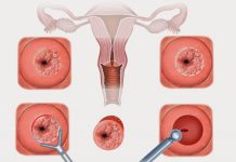 Как проходит лечение эрозии шейки матки