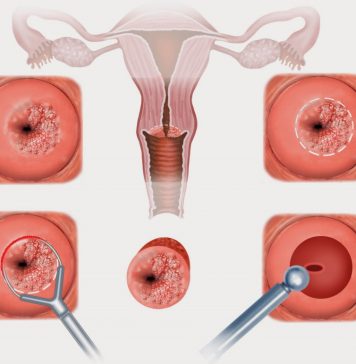 Как проходит лечение эрозии шейки матки