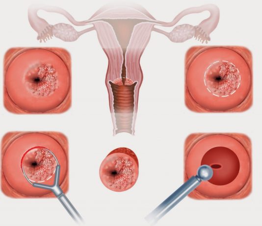 Как проходит лечение эрозии шейки матки