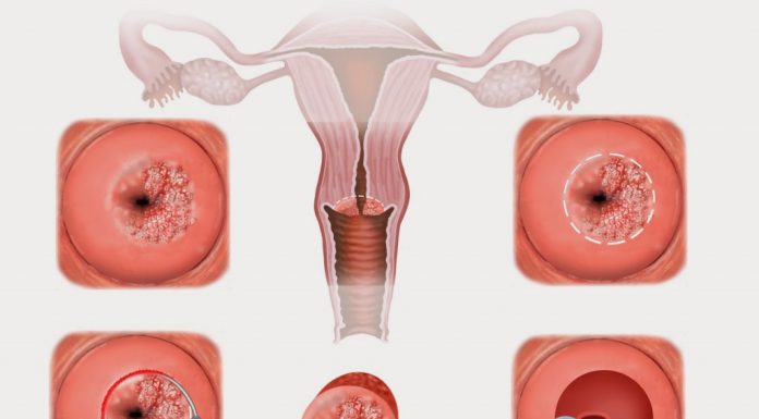 Как проходит лечение эрозии шейки матки