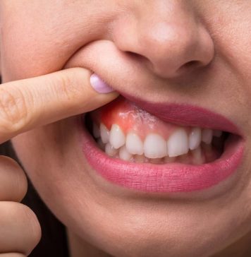 Как происходит лечение флюса и почему это важно сделать