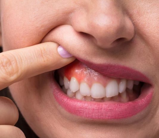 Как происходит лечение флюса и почему это важно сделать