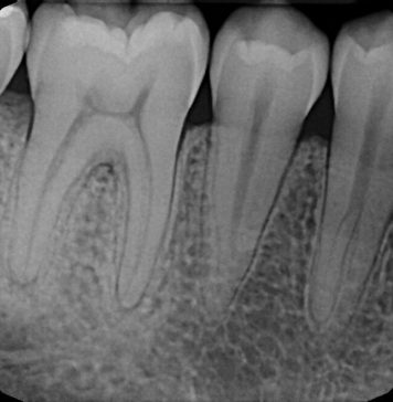 Зачем делаются прицельные снимки зубов