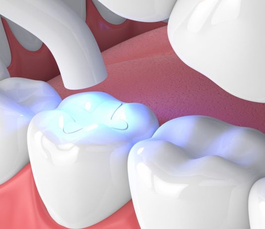 Все способы восстановления зубов и чем они отличаются
