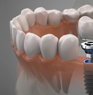 Какие проблемы решит имплантация зубов