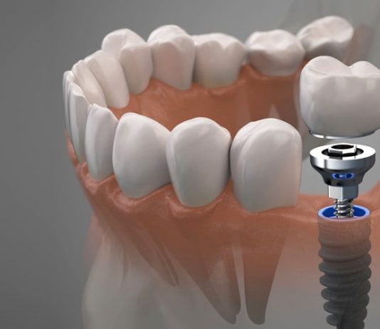 Какие проблемы решит имплантация зубов