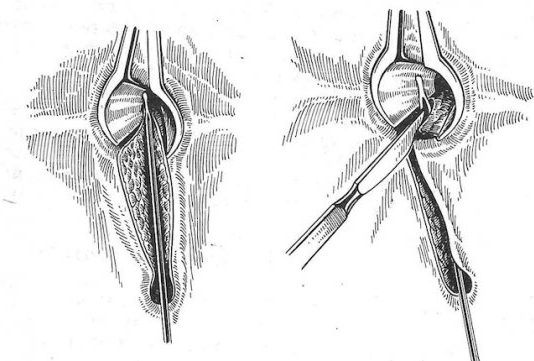 Чем чревато иссечение свищевых ходов