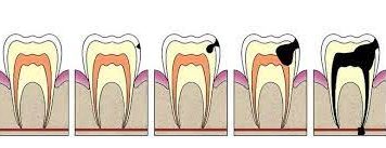 Кариес: как лечить?