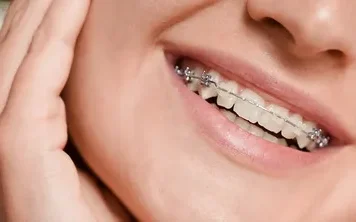 Улыбка по правилам: как брекеты в клинике «ИМПЛАМЕД» меняют жизнь
