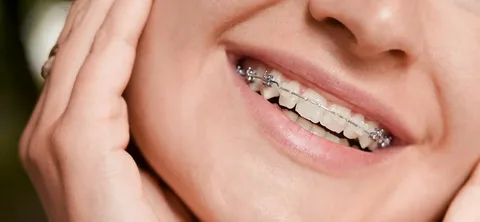 Улыбка по правилам: как брекеты в клинике «ИМПЛАМЕД» меняют жизнь
