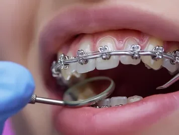 Брекеты без страха: что происходит при установке и как к этому подготовиться