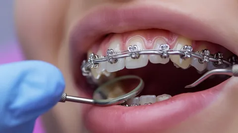 Брекеты без страха: что происходит при установке и как к этому подготовиться