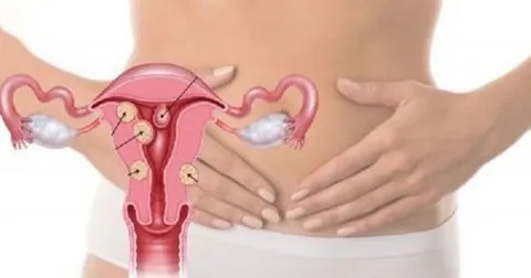 Сохранить матку и вернуть качество жизни: как удаляют миому без удаления органа