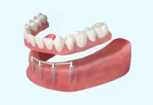 Новая улыбка: как выбрать и жить с зубными протезами