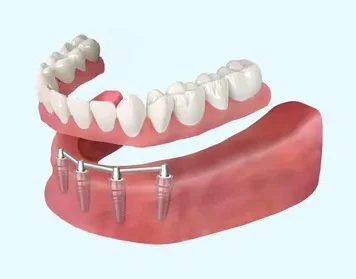 Новая улыбка: как выбрать и жить с зубными протезами