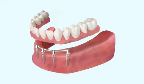 Новая улыбка: как выбрать и жить с зубными протезами