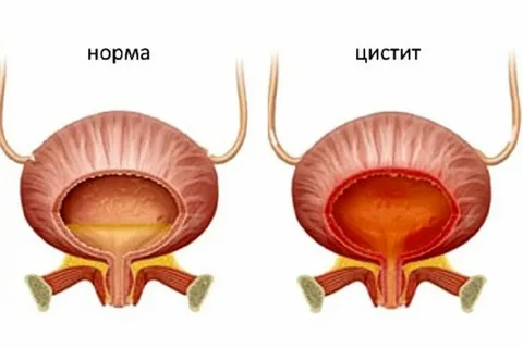 Цистит и уретрит: что важно знать, когда инфекция возвращается снова